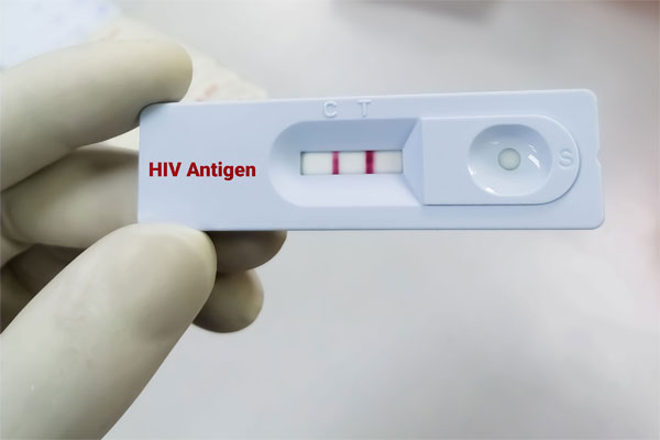 آزمایش HIV